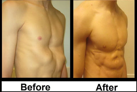 Pectus patient (15 years old) before surgery and after surgery photo.